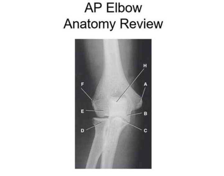 AP Elbow Radiograph Quiz