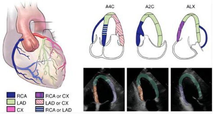 Heart wall segments/Coronary arteries PLAX TTE Quiz