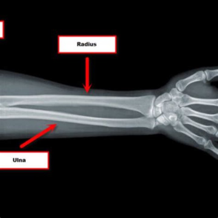 Radius and ulna x-ray Quiz